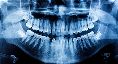 دندان عقل همیشه کشیدنی نیست