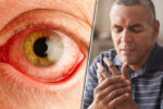 آرتریت روماتوئید چگونه بر چشم‌ها اثر می‌گذارد؟